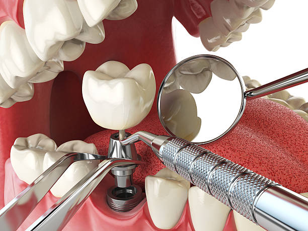 Best Emergency Root Canal Treatment in Live Oak, TX